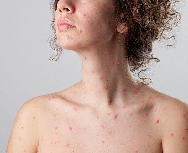 Rubella In Pregnancy: Things You Need To Know - HealthCare2day