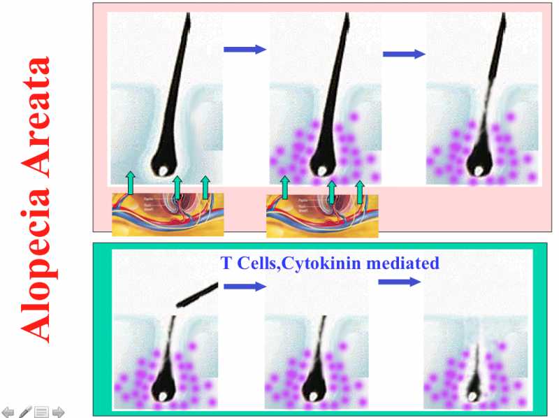 Ruxolitinib A Cancer Drug Restores Hair Growth In Alopecia Areata
