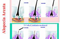 Ruxolitinib a cancer drug restores hair growth in Alopecia areata