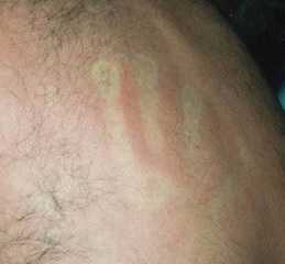 SKIN Manifestations In DENGUE FEVER 