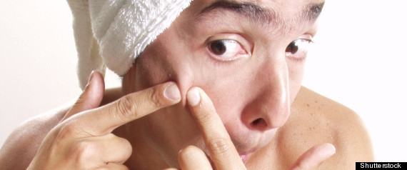 Should I Pop My Pimples? - Blackhead Skincare