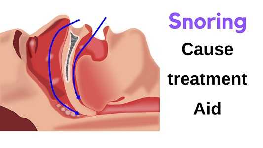 Snoring Aid, Snore Cause, Treatment And Lifestyle Changes - Gyan Share