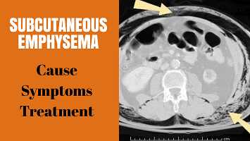 Subcutaneous Emphysema: Cause, Symptoms And Treatment - Gyan Share