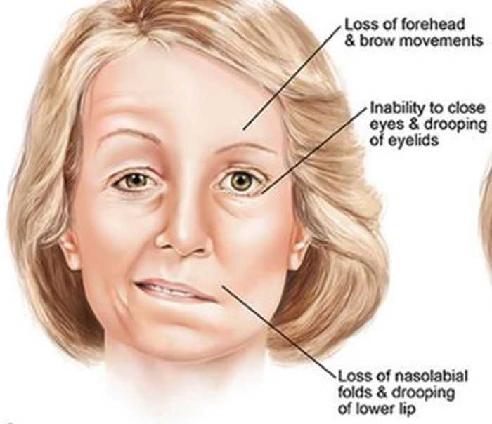 Symptoms And Treatments Of Bell’s Palsy - Theknotstory