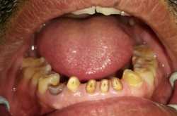 Teeth Wearing Away -Common problem
