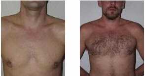 The Improvement Of BHT: A Propelled FUE Methodology