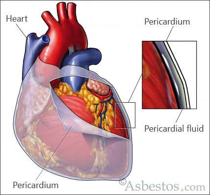 The Pericardial Mesothelioma
