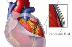 The Pericardial Mesothelioma