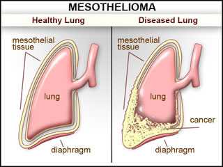 The Pleural Mesothelioma
