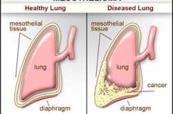 The Pleural Mesothelioma