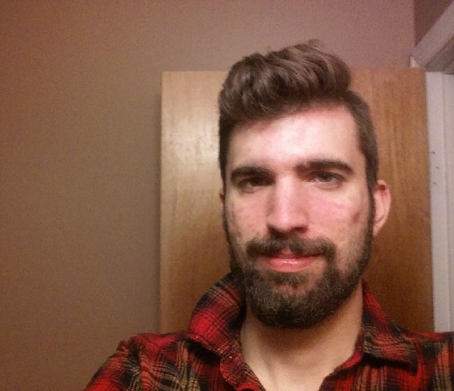 This Young Man Relieved Psoriasis By Reducing Obesity And Stress - Psoriasis Self Management