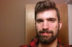 This Young man relieved Psoriasis by reducing Obesity and Stress - Psoriasis Self Management