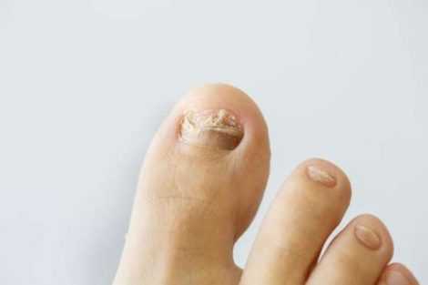 Toenail Fungus: Symptoms, Treatment And Home Remedies | DailyHealthNeeds.com