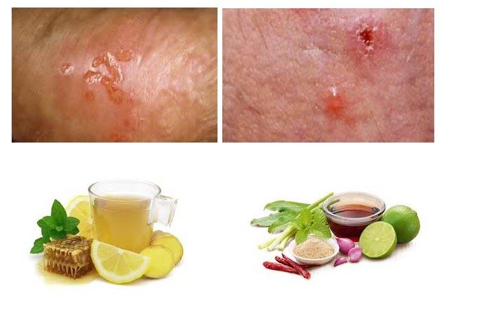 Top 11 Effective Male Yeast Infection Home Remedy