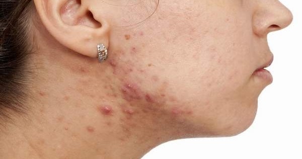 Top Tips For Hidradenitis Suppurativa Natural Treatment