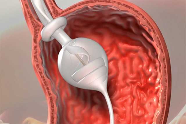 TransPyloric Shuttle: A Non-surgical Device To Treat Obesity