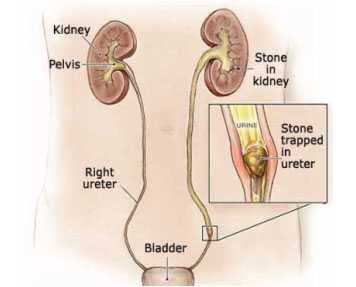 Use Of Alpha 1 Blocker As A Part Of Medical Expulsive Therapy (MET) For Ureteric Stone