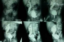 Vesicoureteral reflux (VUR)