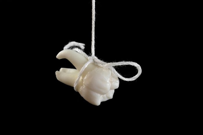 W- WISDOM TOOTH EXTRACTION… #ATOZ2018 #BLOGCHATTERA2Z #A2ZCHALLENGE