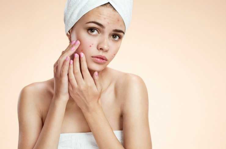 Want To Avoid Breakouts? Break Up With Candy!