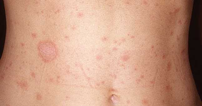 What Is Pityriasis? Know More About It