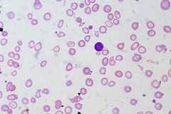 What Is Meant By Anaemia? Deficiency Diseases And Foods To Treat Anaemia | DailyHealthNeeds.com