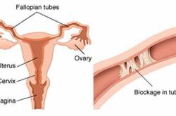 Wow! UnBlock Fallopian Tubes Naturally & Get Pregnant (Step by Step)