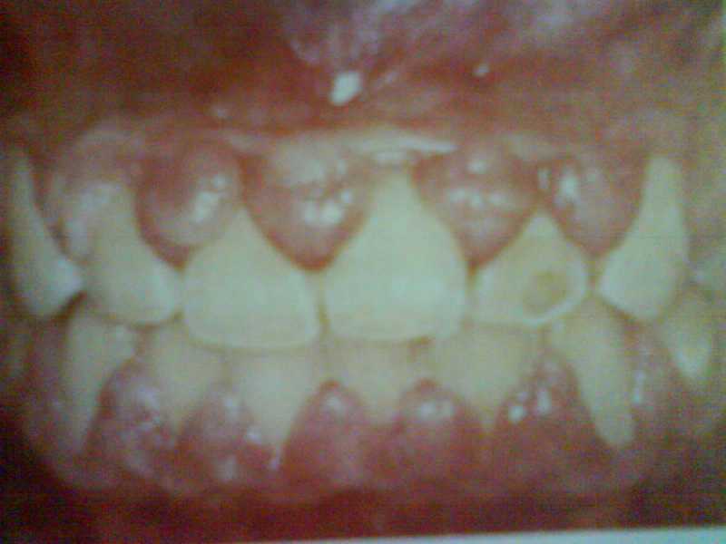 Gingival Enlargement