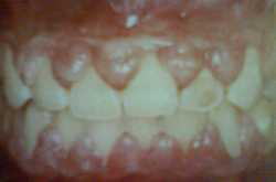 gingival enlargement