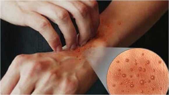 Khujli Ke Upay With Khujli Home Treatment खुजली के उपाय