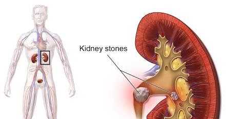 Kidney Stone à¤à¤¾ à¤¯à¥ Ayurvedic Treatment à¤à¥ à¤¸à¥ à¤à¤¤à¥à¤® à¤à¤°  à¤¦à¥à¤à¤¾ à¤à¤ªà¤à¥ à¤ªà¤¥à¤°à¥